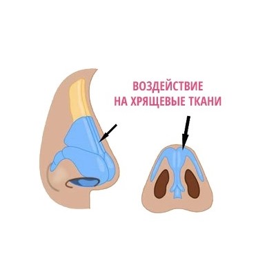 РиноКоррект Лангетка Nose up — для коррекции формы носа без операций